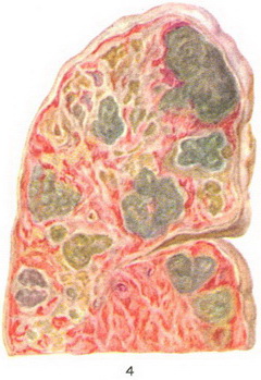 стафілококова абсцедуюча пневмонія