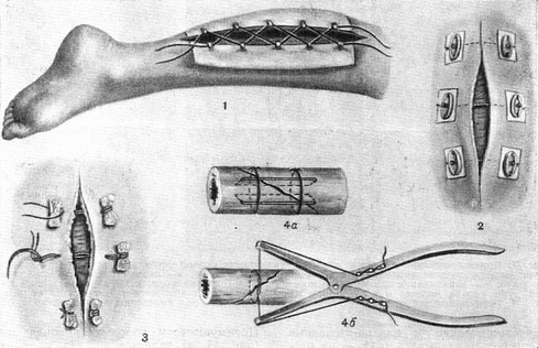 хірургічні шви