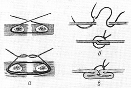 шви для зміцнення фасциально-апоневротических шарів