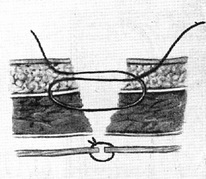 шов по Мозеру