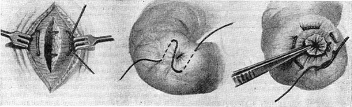 U і Z-подібний шов