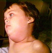 паротит епідемічний (свинка)