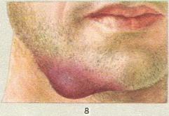 сифілітична гума