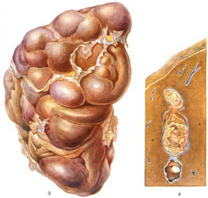 сифіліс печінки
