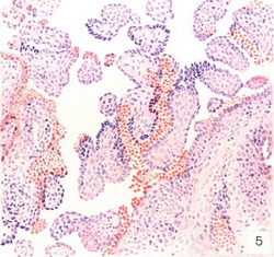 сифіліс плаценти