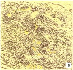 сифілітичний мезаортит