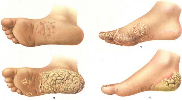 підошовні сіфіліди