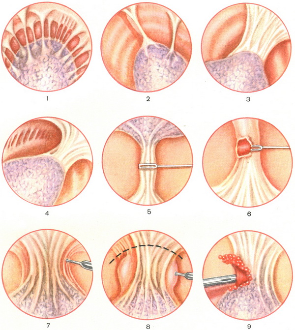 торакокаустика