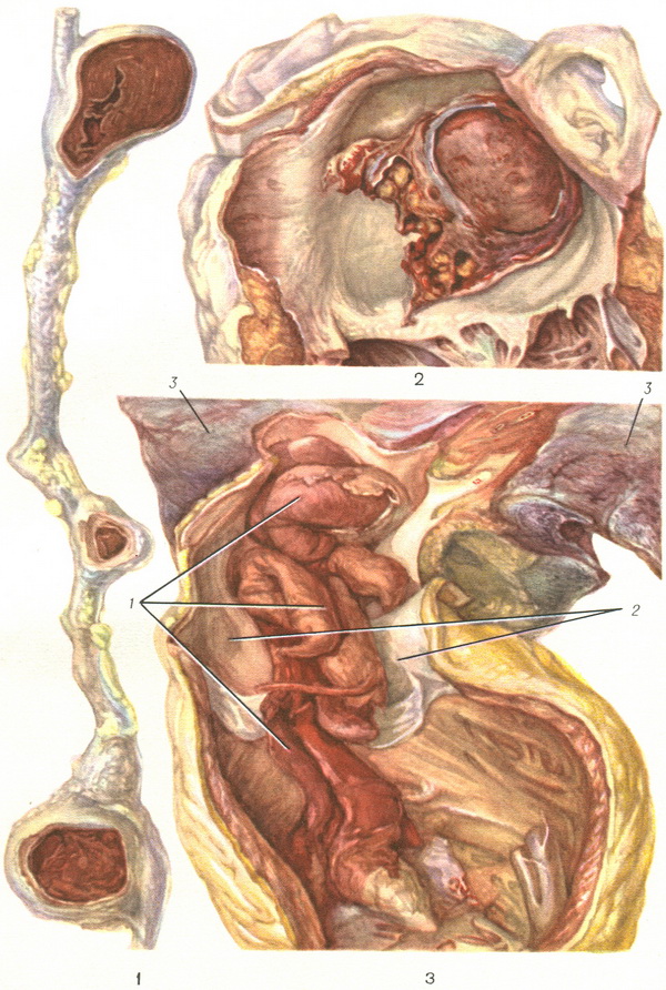 тромбоемболія
