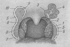анатомічні варіанти піднебінних мигдалин