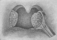 видалення мигдалин