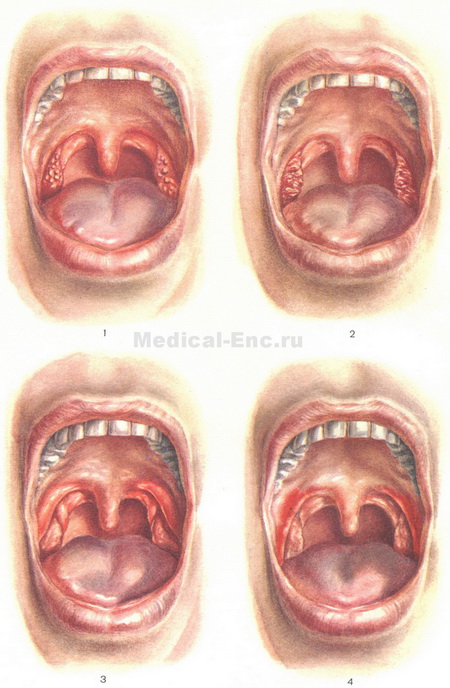 хронічний тонзиліт фото