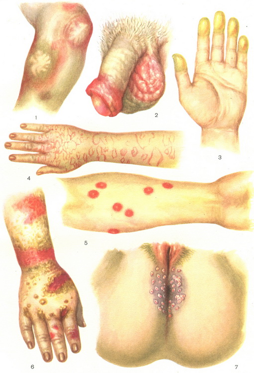 токсидермія фото
