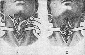 трахеотомія