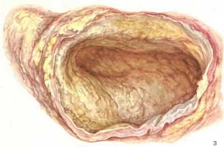 травматична кіста підшлункової залози