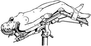 положення Тренделенбурга