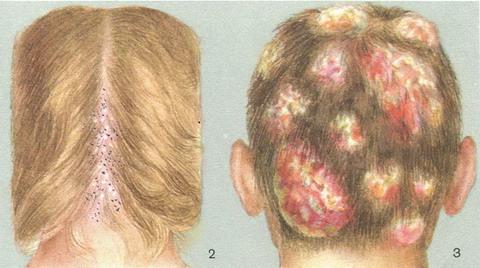 трихофітія (стригучий лишай)