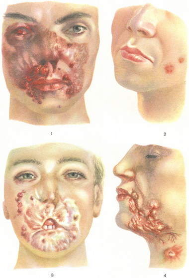 туберкульоз шкіри