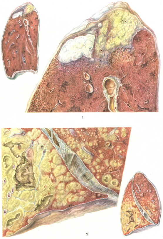 туберкулема і казеозна пневмонія