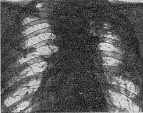 гематогенно-дисемінований туберкульоз