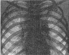 міліарний туберкульоз