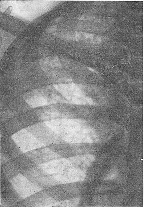 вогнищевий туберкульоз