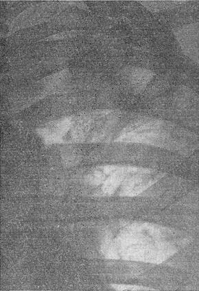 інфільтративно-пневмонический туберкульоз