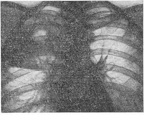 туберкульозний лобит