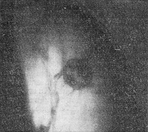 туберкулема