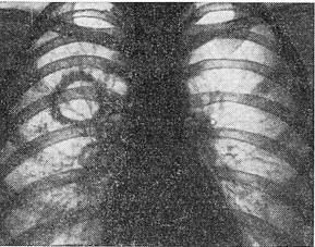 кавернозний туберкульоз