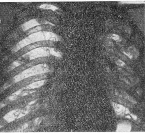фіброзно-кавернозний туберкульоз