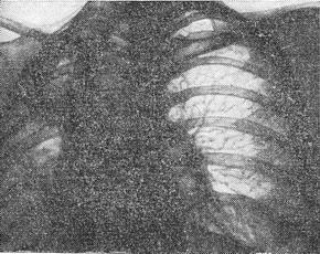 цироз легень