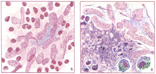 пунктат шийного лімфатичного вузла і печінки при туберкульозі