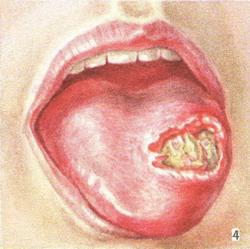 туберкульозна виразка мови