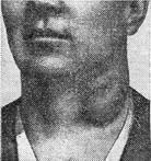 шийний бубон