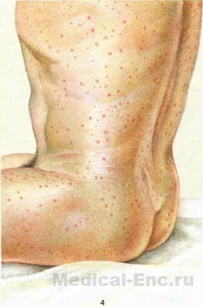 висипний тиф фото