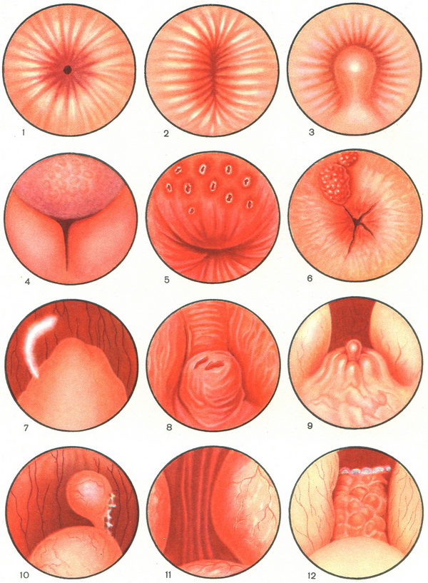 суха і іригаційна уретроскопія