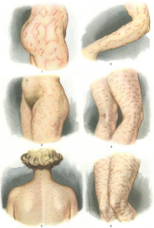 кропив'янка