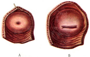 піхвова частина шийки матки