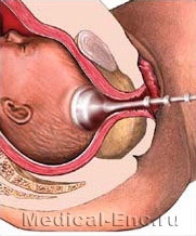 вакуум - екстракція