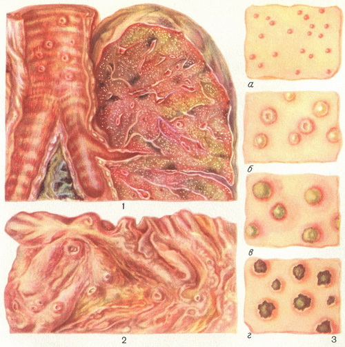 висипання при натуральній віспі