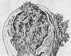 пузирний замет
