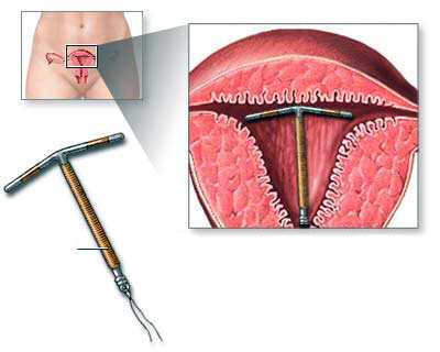 внутрішньоматкова спіраль
