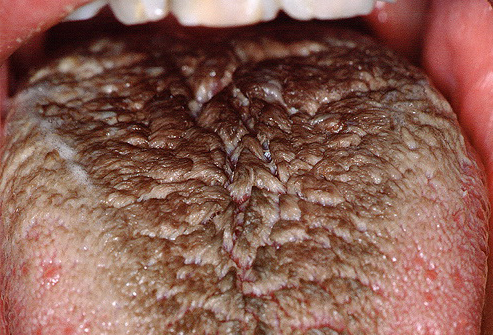 волохатий чорний язик