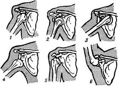 вивих плеча