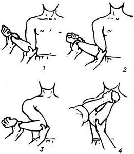 вправлення вивиху спосіб Кохера