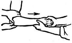 вправлення вивиху передпліччя