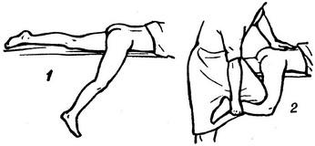 вправлення вивиху стегна за Джанелідзе