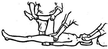 вправлення вивиху стегна по Кохеру - Кефферу