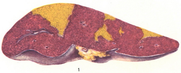 білі інфаркти селезінки